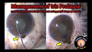 How to fix Iris Prolapse in Cataract Surgery