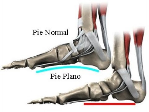 Vendaje de Metatarsalgia (Pie plano)