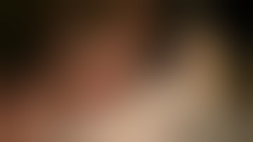 Physics Forceps Extraction of Upper Left Cuspid from GoldenDent, Atraumatic Extraction