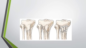 PROXIMAL TIBIAL FRACTURE
