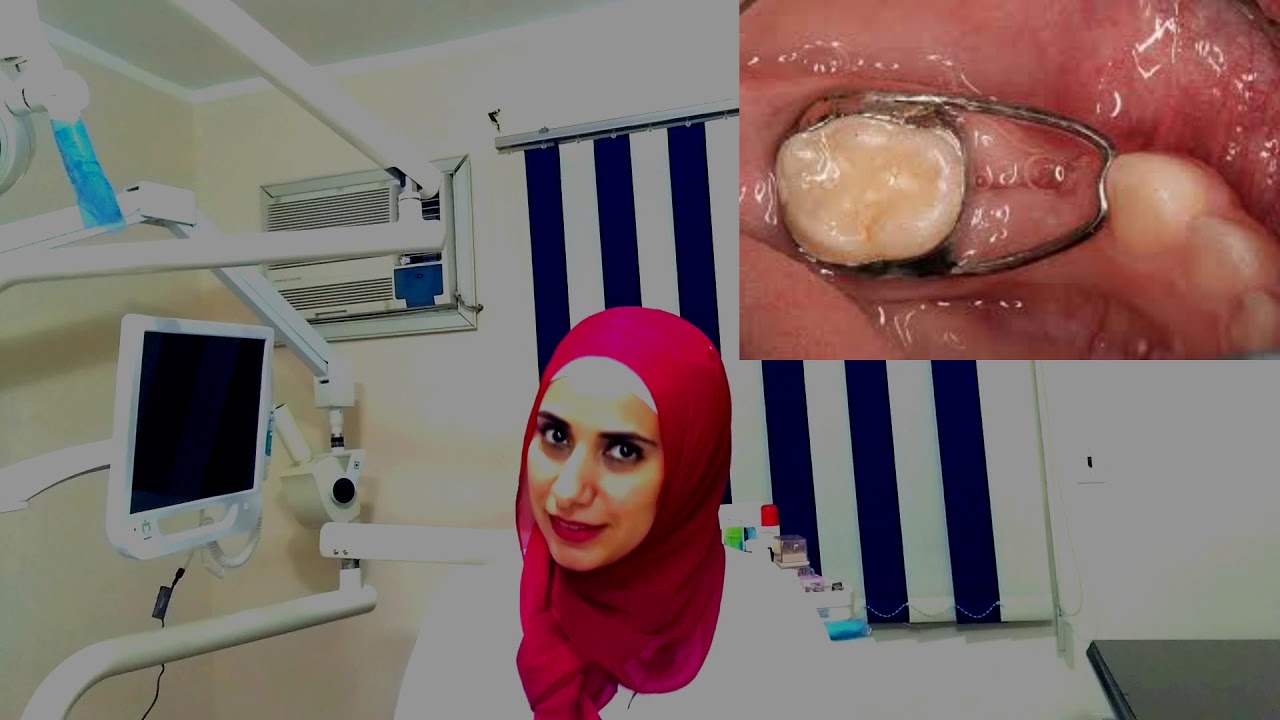 حافظ المسافة لاسنان الاطفال ما له وما عليه