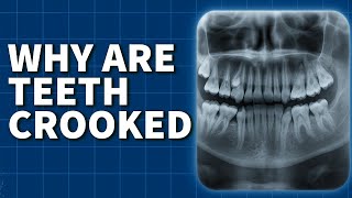 The Science of Crooked Teeth | Dr. Mike Mew Explains the Real Cause