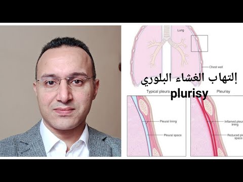 إلتهاب الغشاء البلوري للرئه 