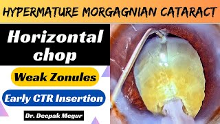 Hypermature Morgagnian Cataract Zonular Weakness Horizontal Chop Technique Dr Deepak Megur