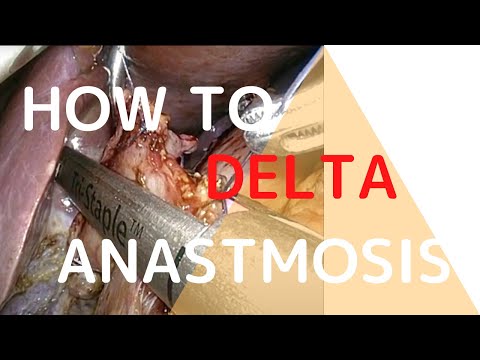 デルタ吻合の方法を手順を追って解説/How to Delta anastomosis