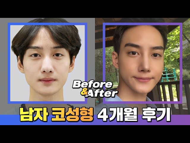 보정없는 남자코성형 후기)코성형4개월 후기_남자코성형으로 존잘남 인생 시작됐다