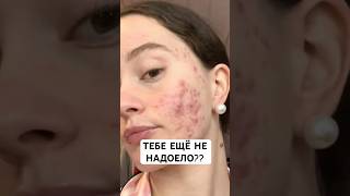 Избавиться от прыщей можно легко и безболезненно! Делюсь своей находкой ☝🏻