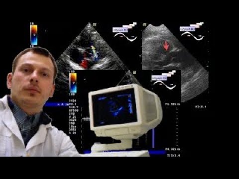 Pediatric Cardiac ultrasound - Tetralogy of Fallot on echocardiography