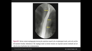 Esophageal Perforation
