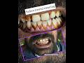 Dental cleaning! Teeth whitening! Teeth cleaning #dentalwork -#dentist #indiandentist