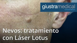 Nevos: tratamiento con Láser Lotus (21051)