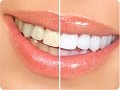 Fastest way to whiten teeth
