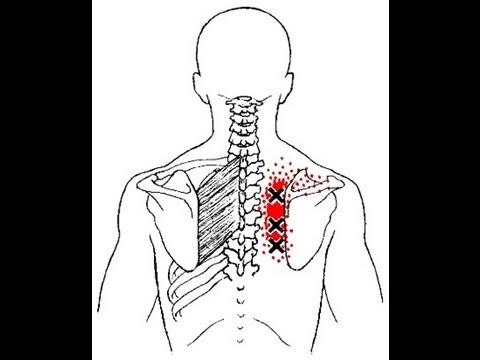 Pain Between the Shoulder Blades from Rhomboid Muscle Trigger Points