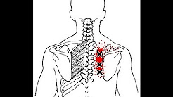 Pain Between the Shoulder Blades from Rhomboid Muscle Trigger Points: Referred Pain Patterns