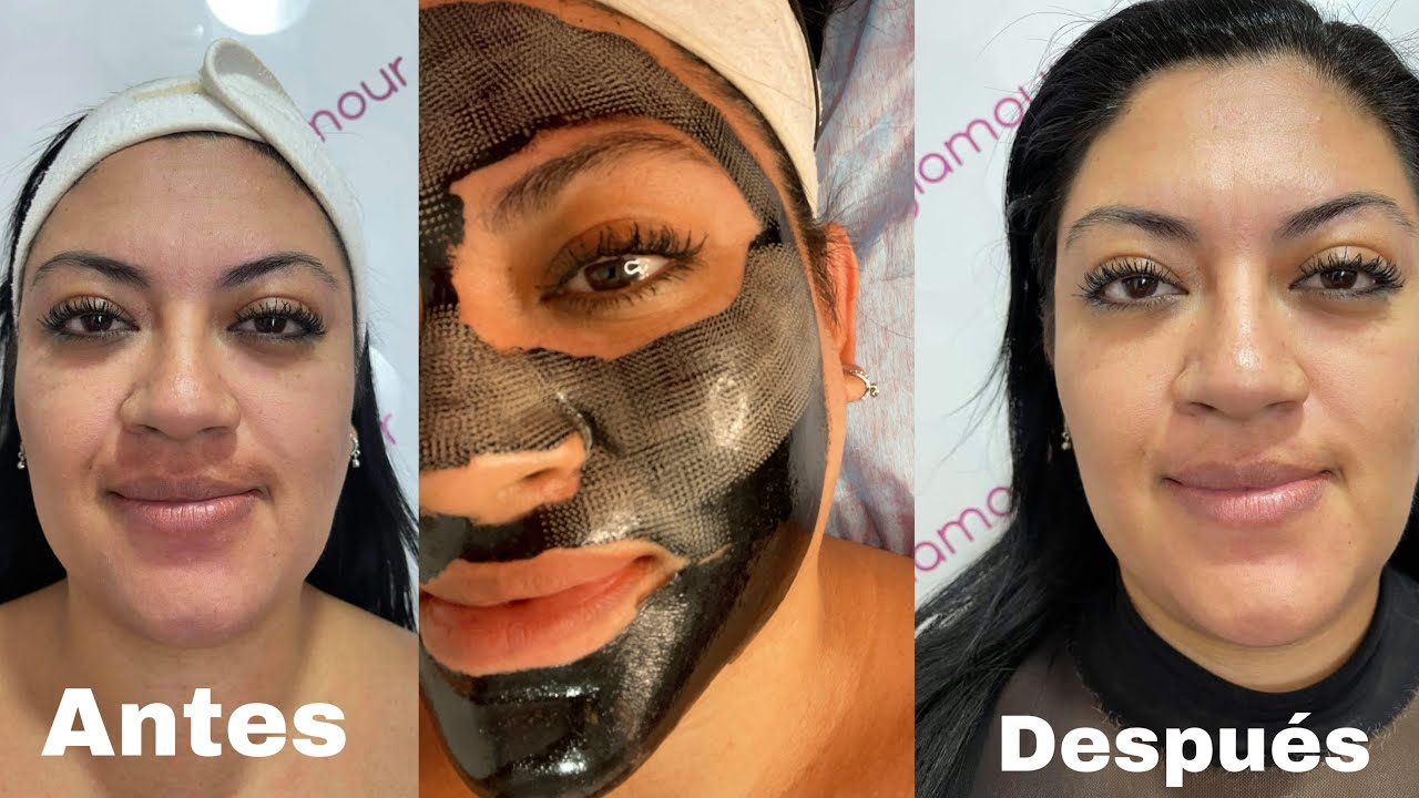 INCREÍBLE!! Quita marcas de acné, pigmentación en la piel, líneas de expresión y rejuvenece 😱