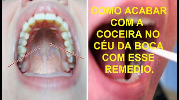 Qual remédio para coceira no céu da boca?