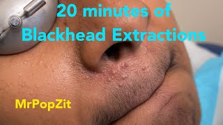 Tons of Blackheads part 2. Extractions of blackheads, whiteheads, milia. Nose, lip, and ear pops.