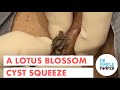 A Lotus Flower Blossom Cyst Squeeze