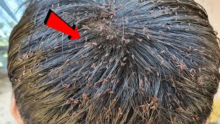 Head lice combing - Big lice removal at home