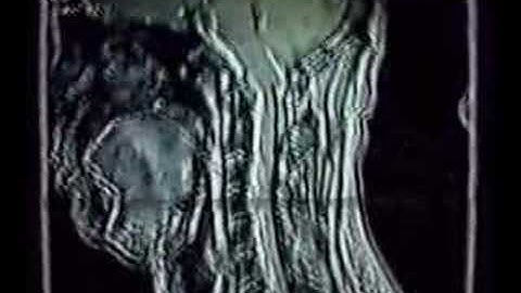 CSF Flow after chiropractic adjustment #1