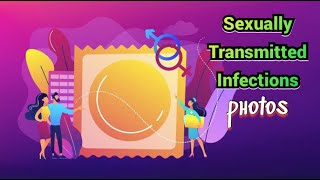 Sexually Transmitted Infections (photos) - CRASH! Medical Review Series screenshot 2