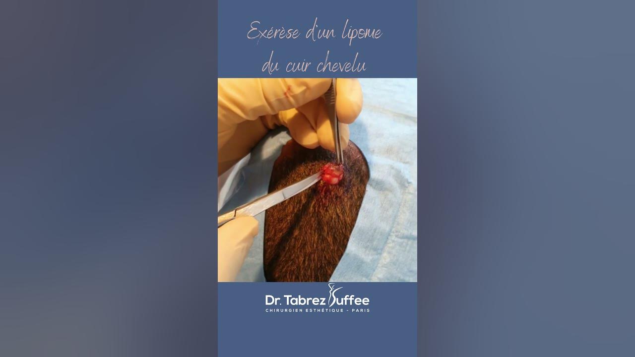 Chirurgie dermatologique Lipome du cuir chevelu YouTube