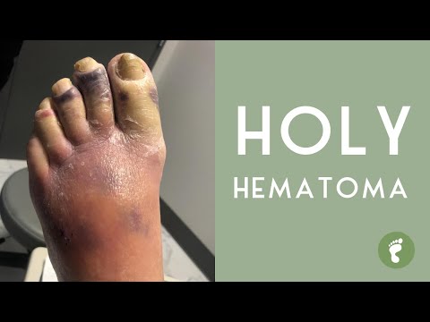 Video: Kallonsisäinen Hematoma - Hoito, Tyypit, Oireet