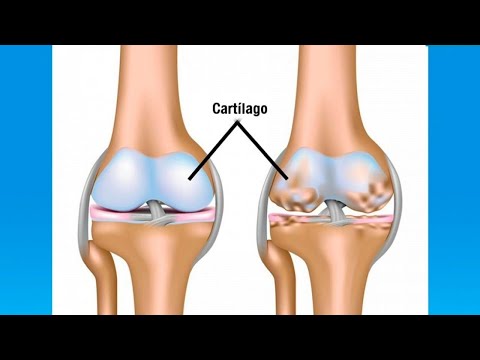 Conozca las complicaciones de la osteoartritis