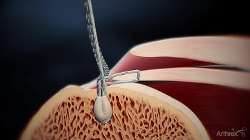 Delaminated Rotator Cuff Repair Surgical Technique Animation