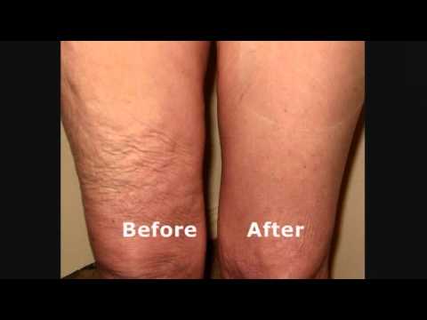 Skinnies Instant Lifts for Thighs - Hide Loose Thigh Skin 