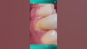 Răng sứ Veneer – Bí quyết giúp bạn có nụ cười hoàn hảo! #nhakhoalumismile #rangsuthammy #dansuveneer