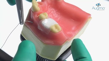 Augma How-To - Socket Grafting without Flap Reflection - Bond Apatite