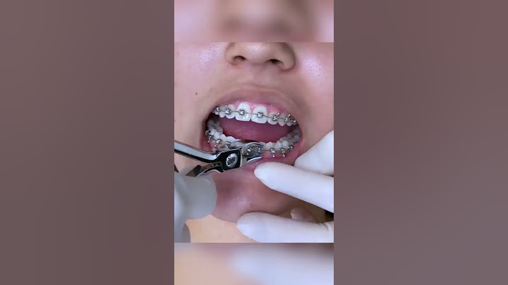 Satisfying Braces Removal w/ The Braces Doc (ASMR) — How we remove braces