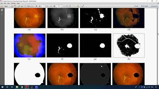 Exudates Detection Using Morphology Mean Shift Algorithm in Retinal Images in Matlab
