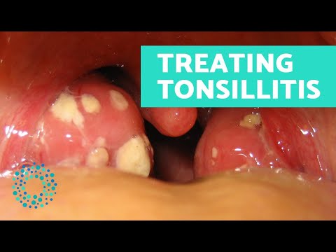 Como tratar TONSILITE naturalmente
