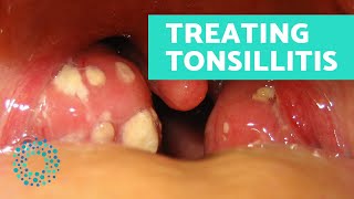 How to TREAT TONSILLITIS naturally