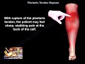 Plantaris Tendon Rupture - Everything You Need To Know - Dr. Nabil Ebraheim