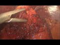 Conversion of nissen sleeve to roux en y gastric bypass