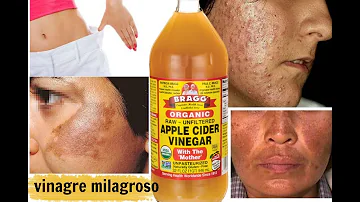 ¿Puedo utilizar vinagre de sidra de manzana para eliminar las manchas oscuras de la cara?