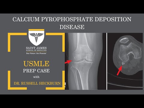 Calcium Pyrophosphate Deposition Disease