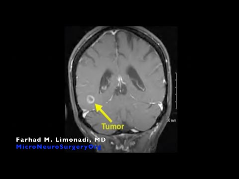 Surgical Footage Of Removal Of Glioblastoma Multiforme (GBM) Brain Tumor (brain Surgery)