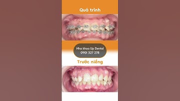 Hành trình LỘT XÁC nhờ niềng răng Minh Thư