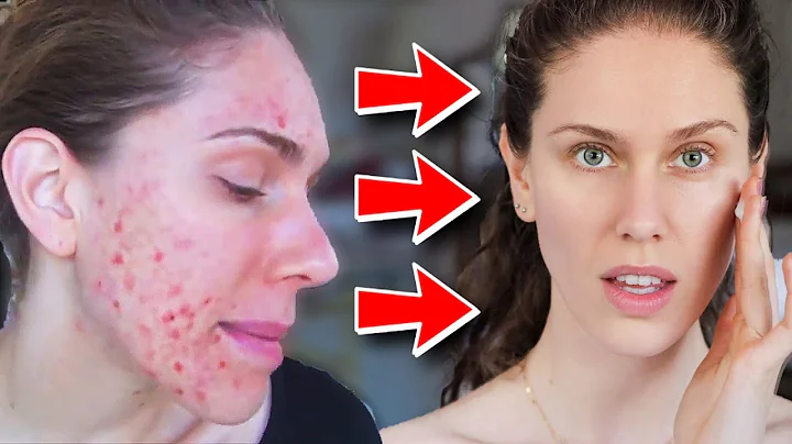 3 Things She Did to GET RID of Her Acne! (Ft. Cass...