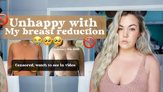 BREAST REDUCTION UPDATE | IM UNHAPPY 😞