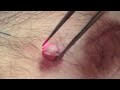 Haemangioma  skin surgery