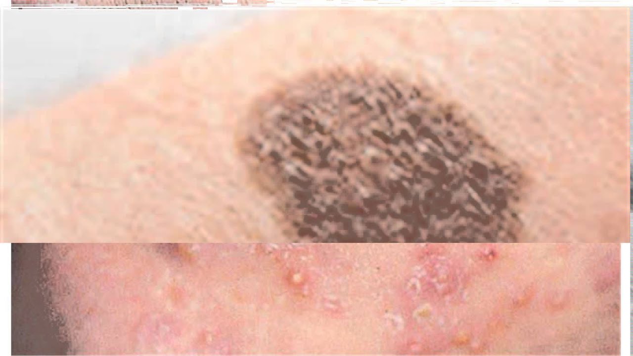 10 Most Common Skin Disorders