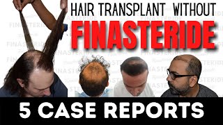 Hair transplant without Finasteride: 5 Case Studies | Darling Buds Clinic