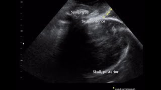 ISUOG practice guideline on intrapartum ultrasound screenshot 5