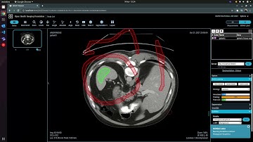 MONAI Label OHIF Scribbles