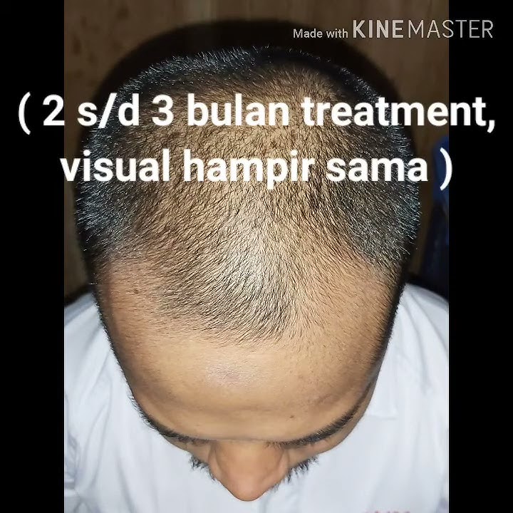 3 bulan pemakaian minoxidil